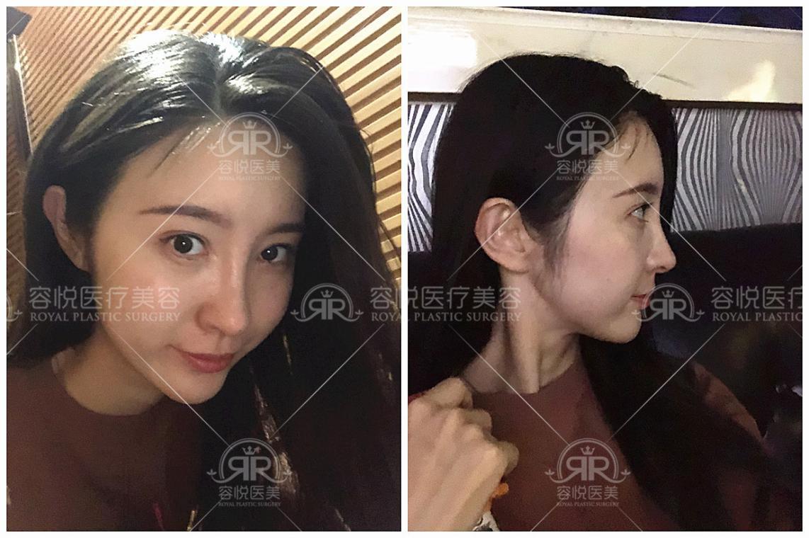 做完隆鼻术后假体透光，我们要怎么修复呢