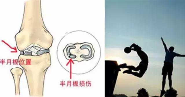 询问半月板损伤有什么特效药吗,半月板二级损伤医生说没事
