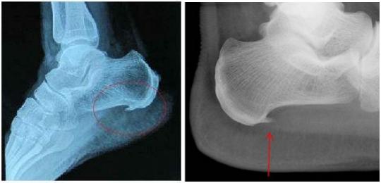 脚后跟长骨刺疼痛怎么缓解,脚后跟骨刺特别疼的最佳治疗方法