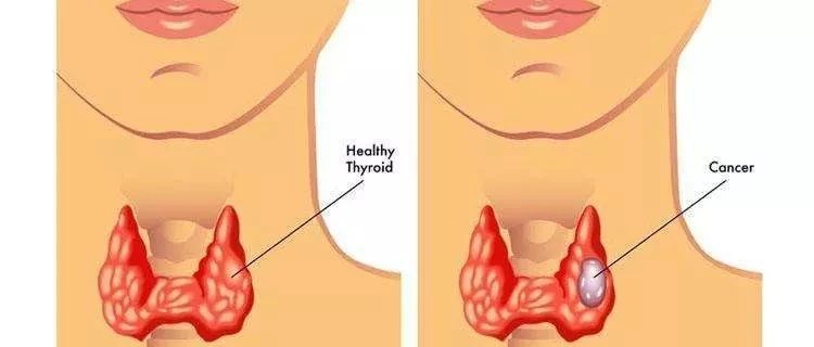 查出结节生活中要注意什么,体检查出甲状腺结节别慌先这样做