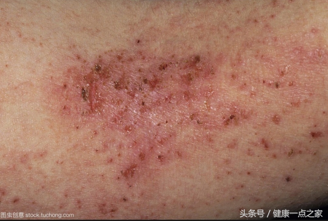 湿疹出现的原因和治疗方法,湿疹的症状和鉴别方法