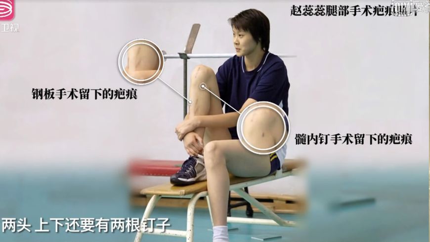 赵蕊蕊腿骨折视频,赵蕊蕊受伤事件