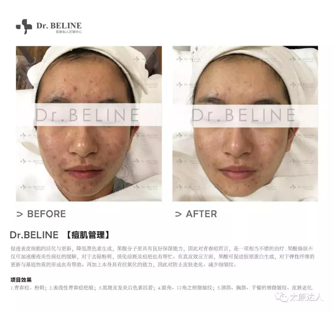 298元！全年无限次黑头管理！Dr.BELINE定制无暇美肌！