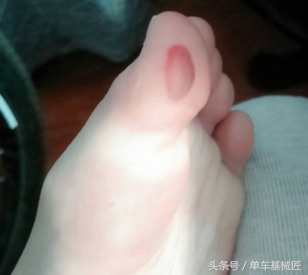 骑自行车磨出了水泡多久自愈,骑行脚上会磨出水泡吗