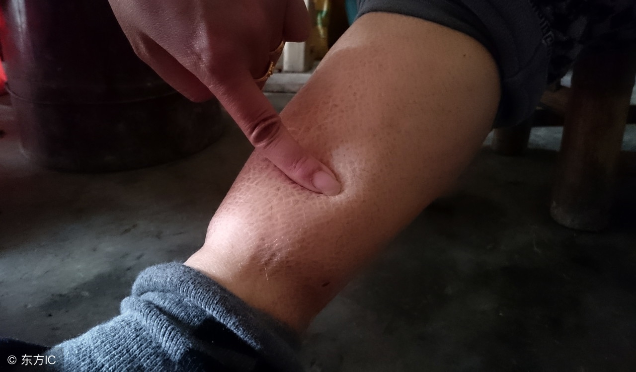 身体浮肿是什么原因吃点什么药,身体不明原因浮肿