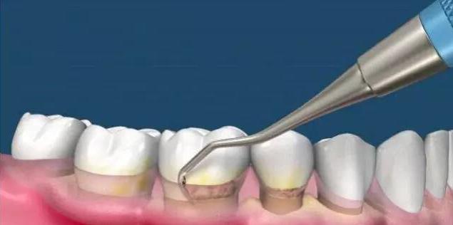 洗牙会导致牙齿敏感吗,洗牙伤害了牙釉质