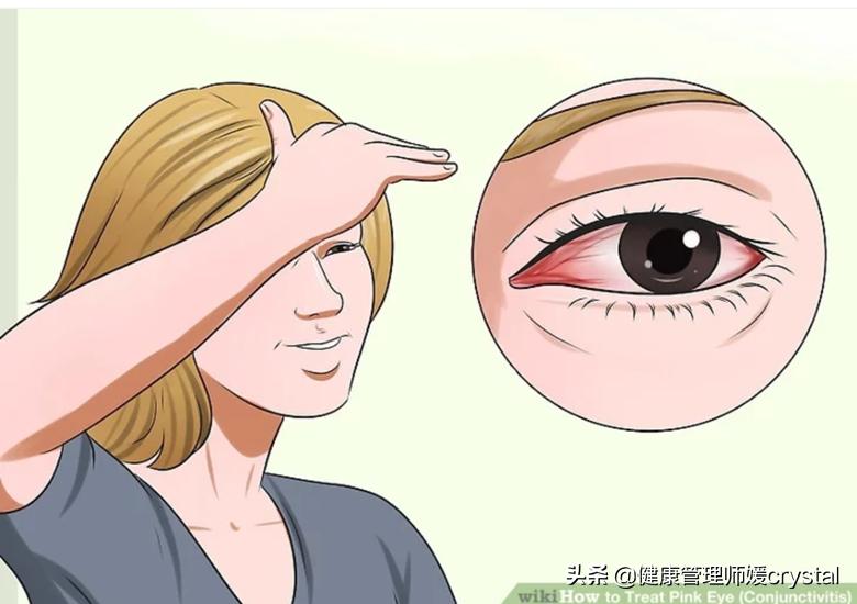 过敏结膜炎用什么眼药水儿童,过敏性结膜炎儿童症状眼药水