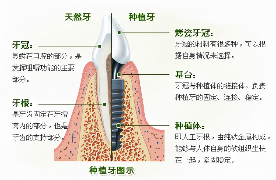 如果不满足种植牙条件缺牙怎么办,种植牙几百几千上万有什么区别