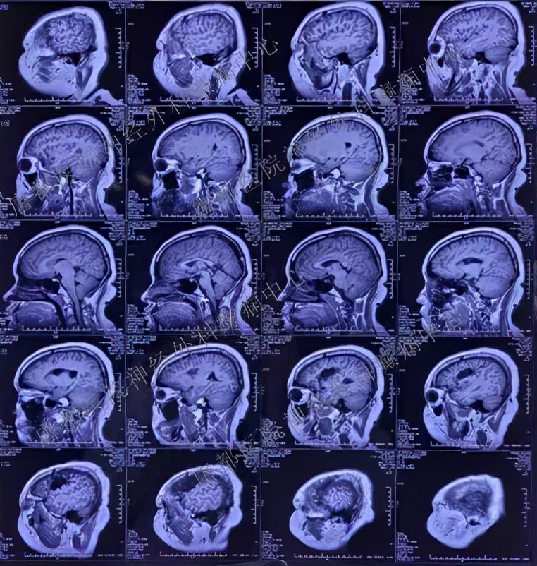唐都医院癫痫手术能不能根治癫痫,唐都医院神经外科癫痫
