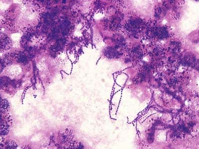 人感染猪链球菌性脑炎吃什么药,猪脑炎链球菌是败血症吗