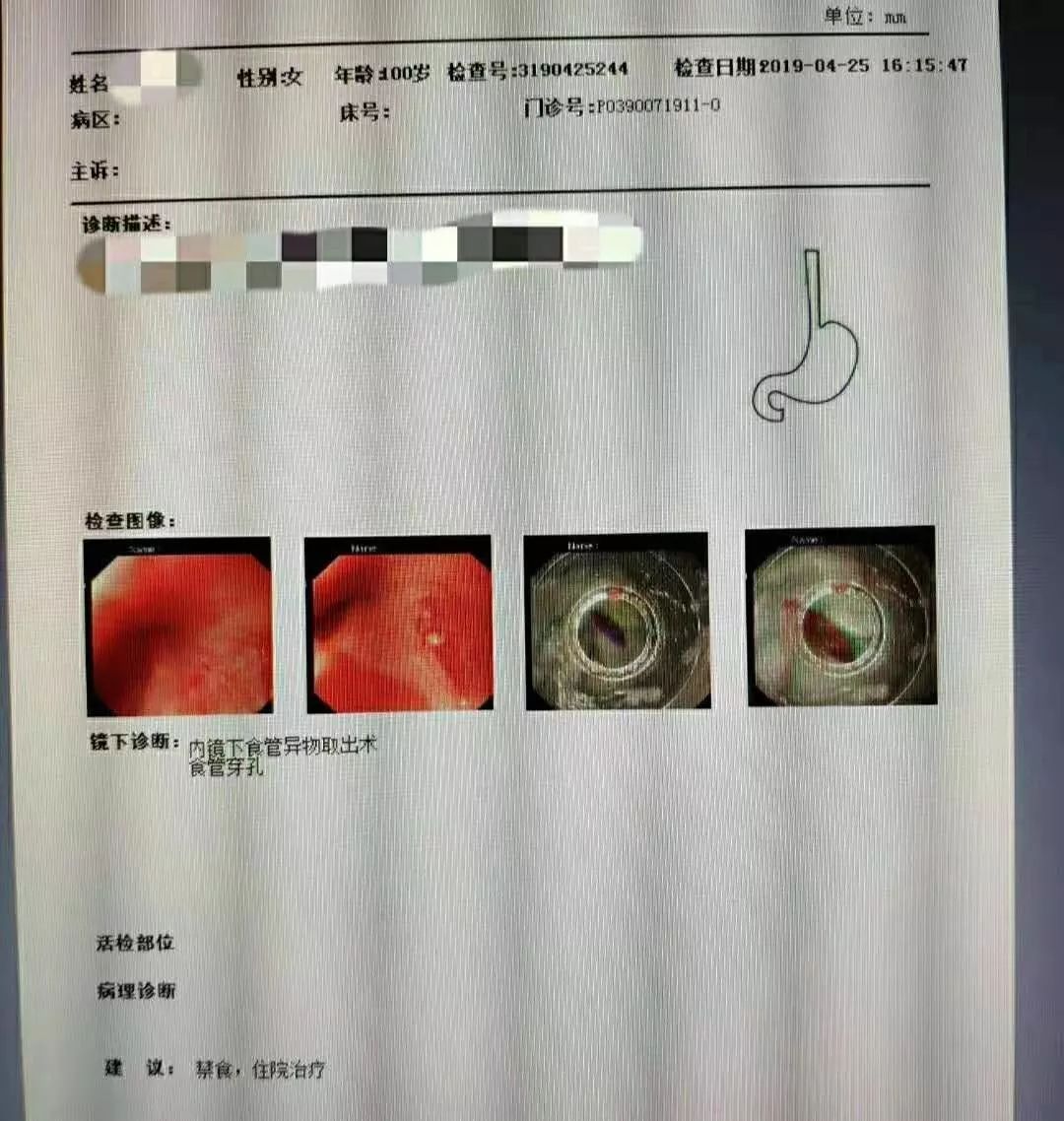 异物卡住喉咙急救方法不能用手掏,急救手册异物卡喉的唯一救命方法