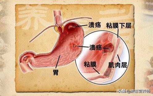 胃炎胃不舒服怎么缓解,老是胃痛慢性胃炎吃什么胃药好