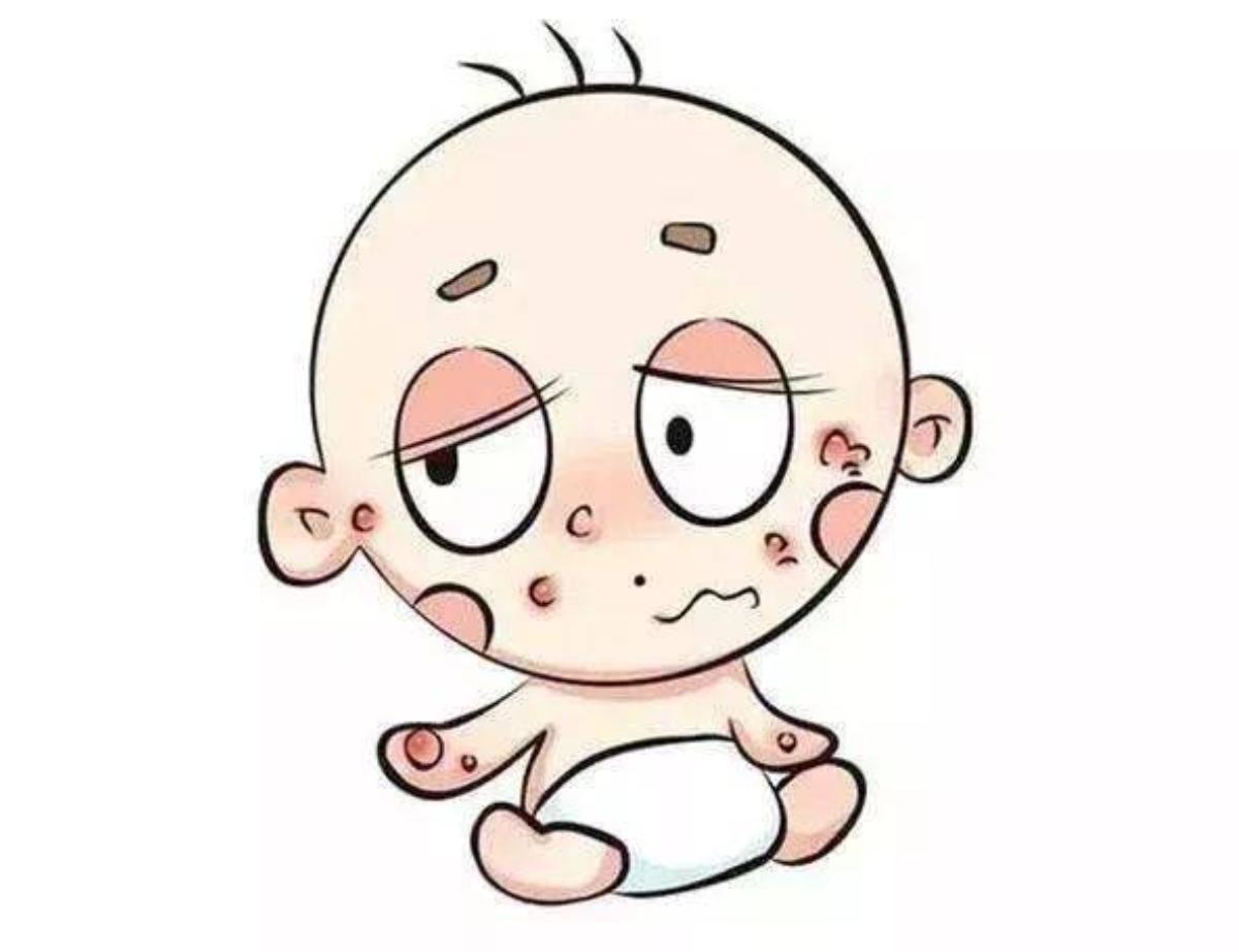 宝宝起疹子的症状有哪些,宝宝起疹子跟孕妈吃东西有关么