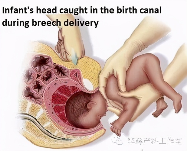 阴式分娩（自然分娩）知情同意书的专业解读