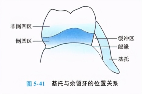 牙列缺损的可摘局部义齿修复题库,牙科美学修复精讲