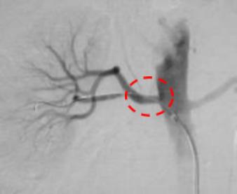 举例科普|介入能治疗哪些疾病?