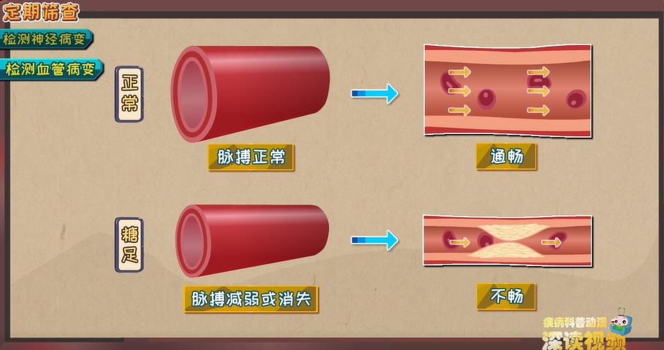 糖尿病足截肢步骤,干性糖足坏疽必须截肢吗