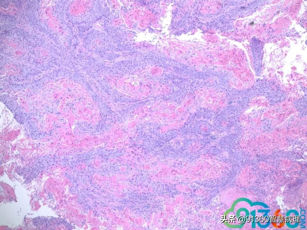 病理宫颈活检lsil是什么意思,宫颈病理检查与tct检查的区别