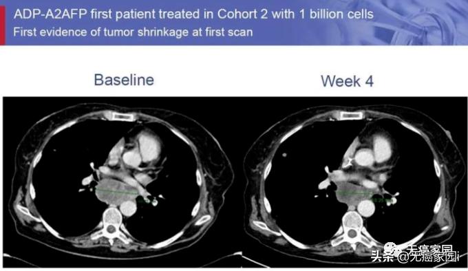 吴孟达肝癌去世的背后,赵英俊吴孟达肝癌