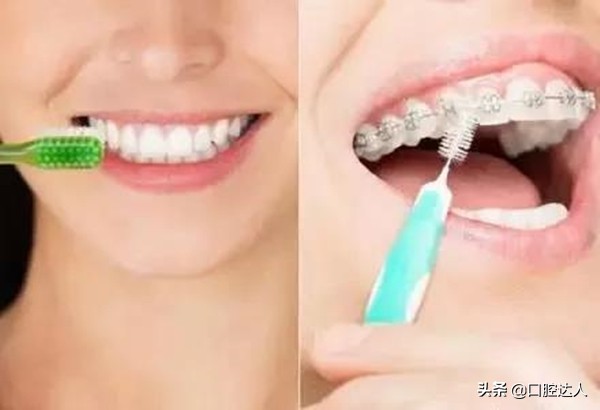 陶瓷半隐形牙套的优缺点,透明托槽和隐形牙套的区别