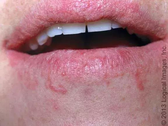 宝宝上火引起的烂嘴角该怎么治疗,宝宝烂嘴角的原因