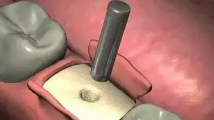 3d打印种植牙与传统种植牙的区别,种植牙是怎样种植的如何操作