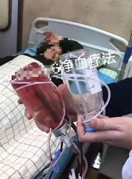 减肥出大事!用了网上爆红的方法,23岁姑娘紧急“换肝”捡回一条命