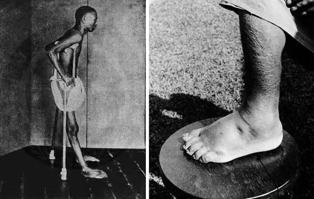 日本皇室的脚气病,脚气传到头上的症状