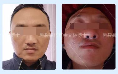 余文林博士修复唇裂多少年了,余文林唇裂二期修复大概多少钱