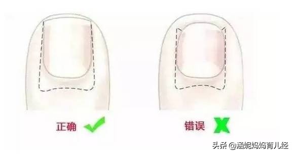 孩子脚趾边疼是甲沟炎吗,孩子脚趾指甲盖突然疼痛