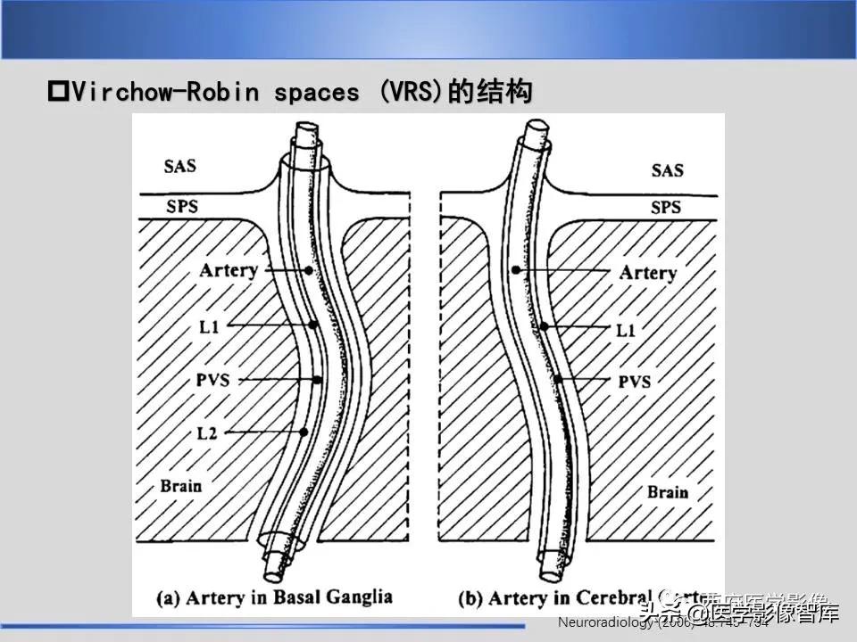 vr间隙概念,vr间隙需要做什么检查