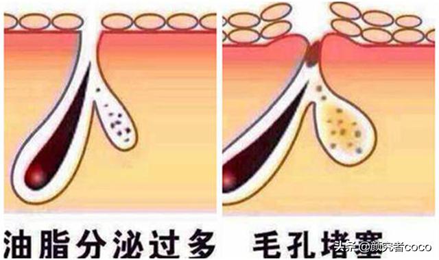 祛痘微针为啥一直爆痘,黄金微针后爆痘