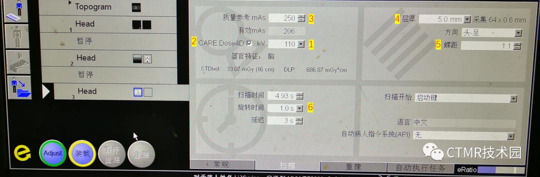 CT影像技术,脑部做ct有伪影是怎么回事