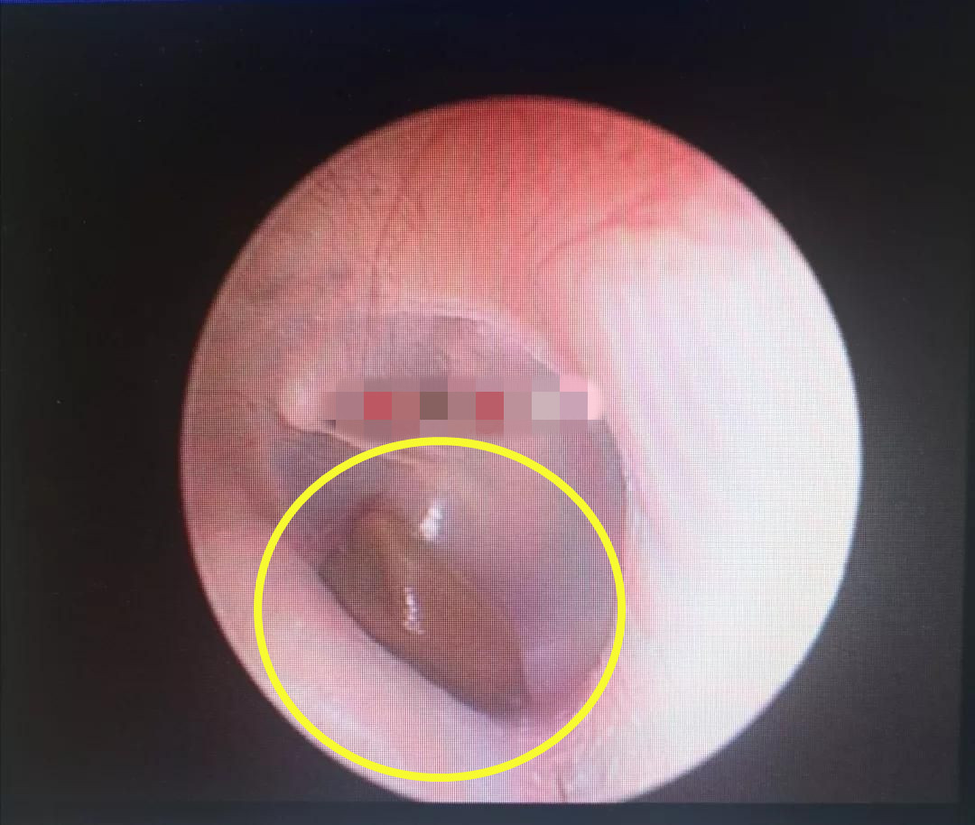 6岁男孩突然说耳朵疼,6岁男孩突然喊耳朵痛