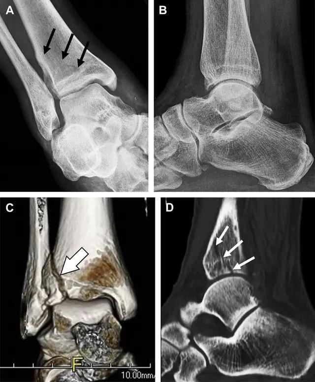 几种严重骨折医学名称,常见的骨折有哪些名称