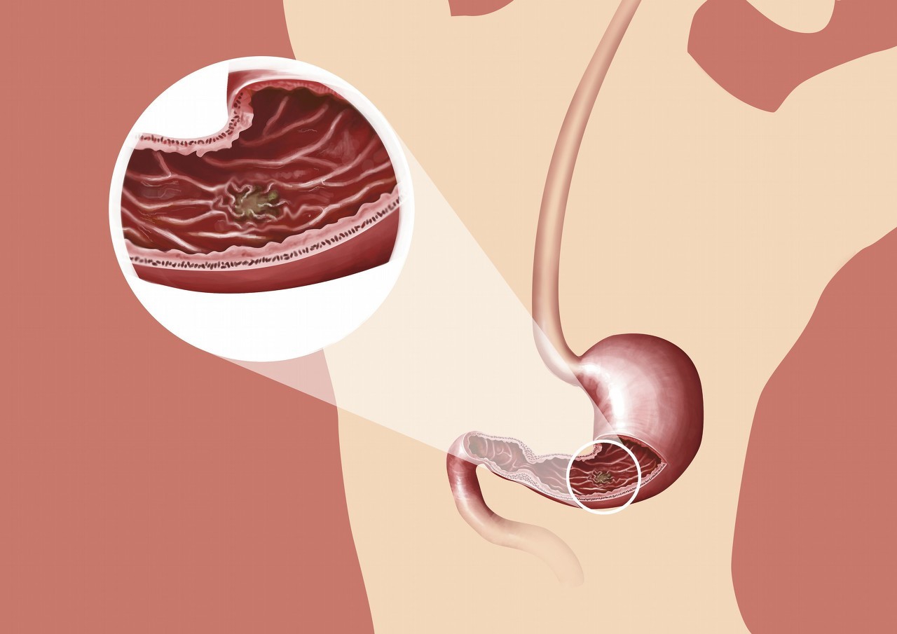胃部胀气灼热痛是胃癌吗,胃溃疡经常腹痛腹胀是什么原因