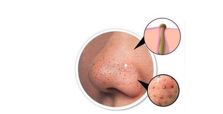 鼻子上挤出来的白色丝状物到底啥,鼻子上挤出来的白色丝是什么