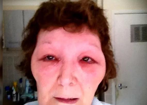 英国女子被假医生注射肉毒杆菌,脸部肿胀像外星人,差点丧命