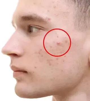 挤痘痘挤到一半就挤不出来了,痘痘挤破了怎么快速消痘