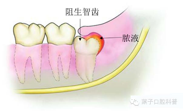 拔智齿：讳疾忌医有什么后果？#葉子口腔科普#