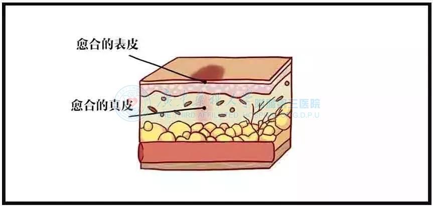 为什么伤好了会留疤,为什么一个小伤口愈合后都会留疤