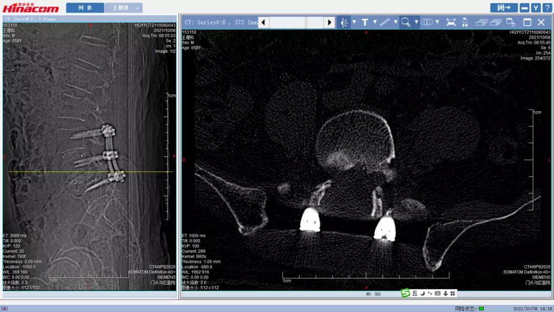 再也不用歪着身子走路了—区医院脊柱中心（骨二科）成功实施腰椎间盘摘除、椎间植骨融合钉棒内固定术