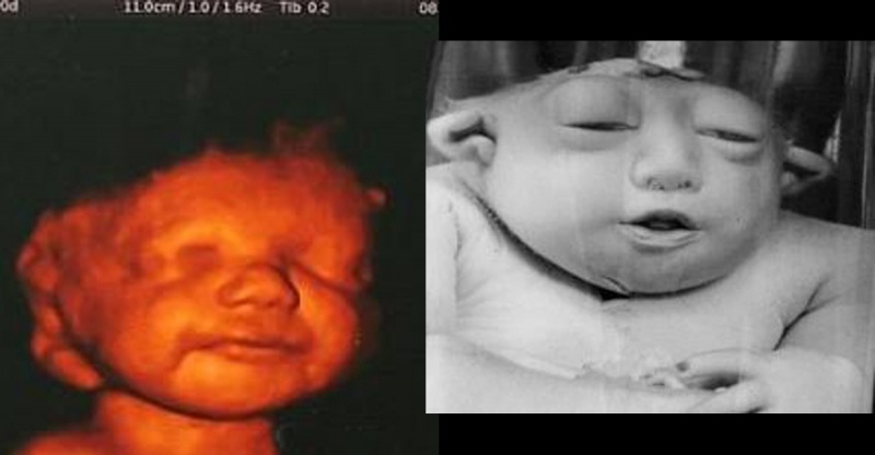 感冒吃药后发现怀孕影响胎儿吗,刚怀孕感冒发烧吃了药孩子能要吗