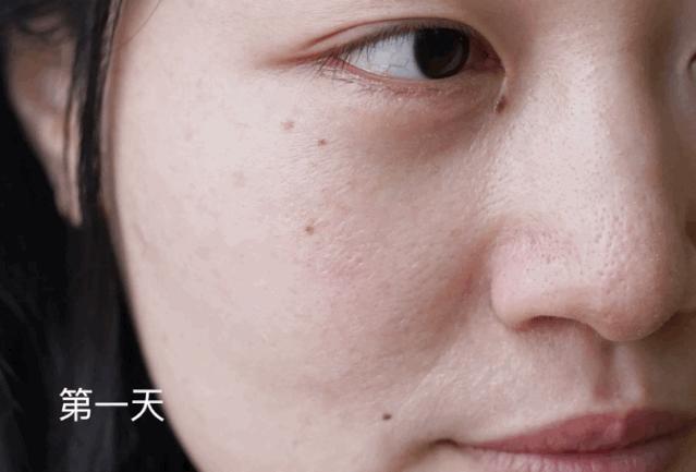 有黑头和没黑头有什么区别,没有长过黑头却长黑头怎么办