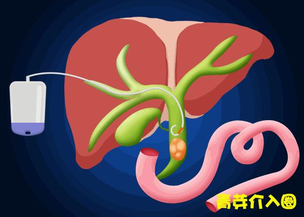 胆道阻塞眼睛发黄图片,胆管堵塞全身发黄中医治疗