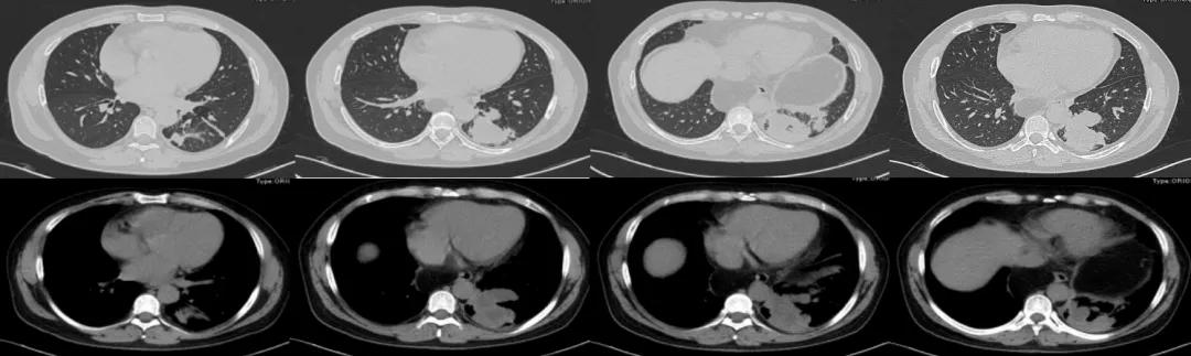 咳嗽10多天了有白痰细菌感染,咳嗽是肺部真菌感染吗