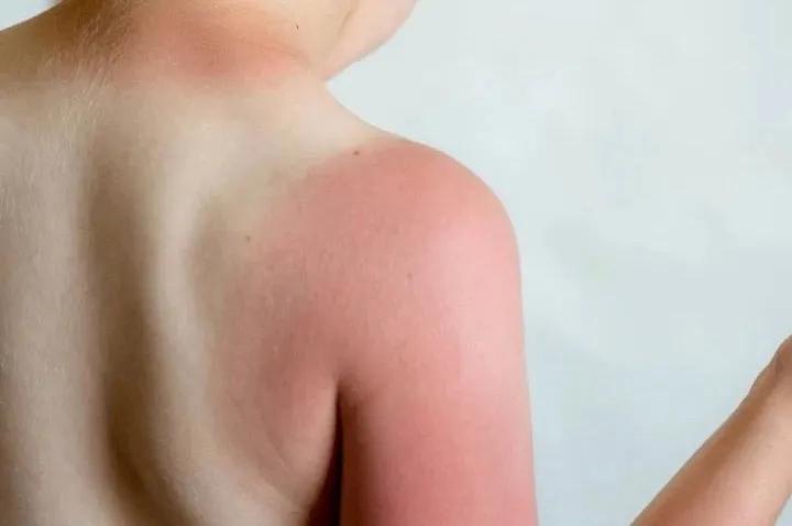 宝宝三岁前晒伤,别等孩子晒黑晒伤才开始涂防晒