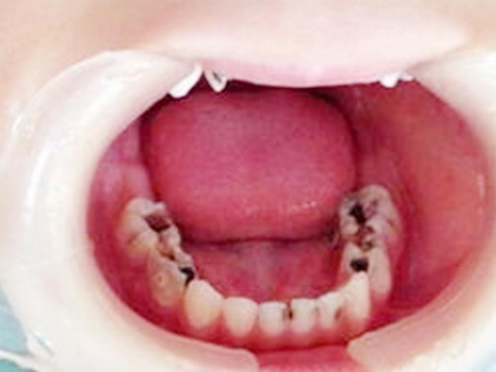 小孩满口牙蛀牙是怎么回事,孩子满嘴蛀牙严重能修复吗