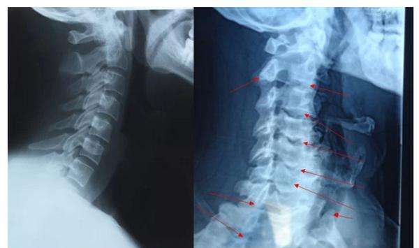 颈椎腰椎骨刺怎么治才能彻底根除,腰椎和颈椎骨刺的治疗方法