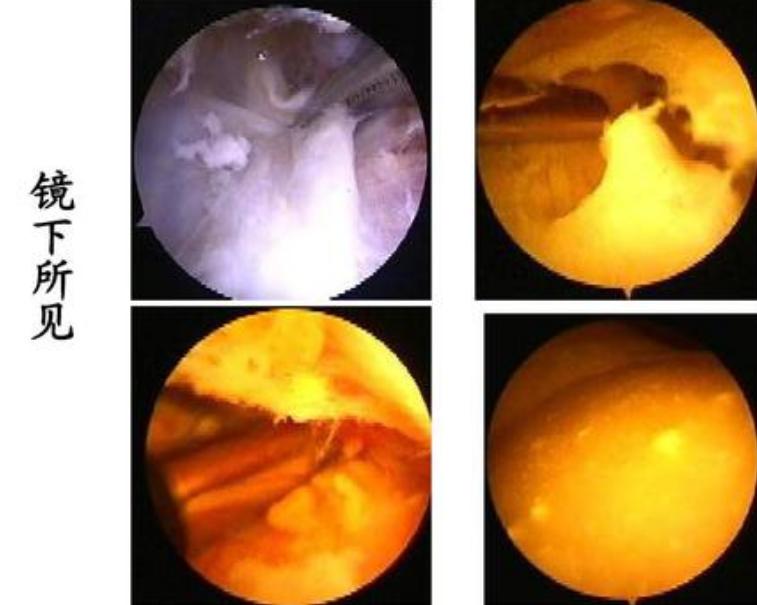 腘窝囊肿手术几天能出院,腘窝囊肿快速消除小妙招